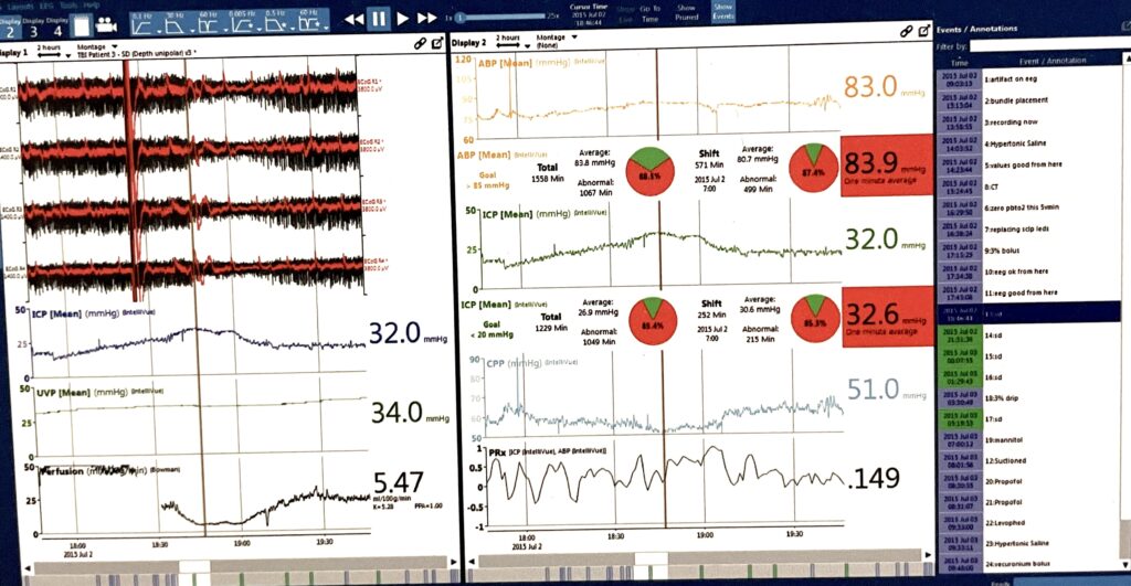 CNS Monitor showing detection of spreading depolarizations