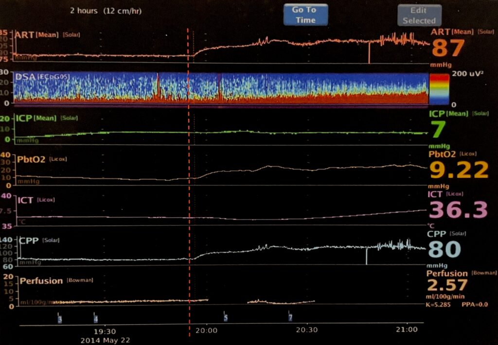 Moberg Analytics CNS Monitor Synchronized Data