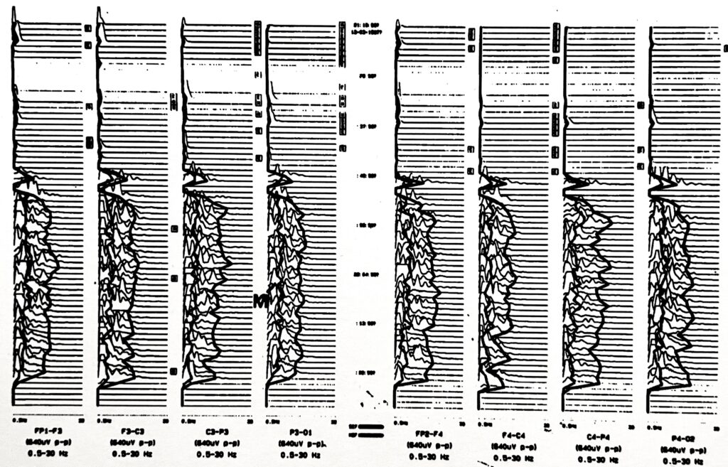 Neurotrac II Compressed Spectral Array (CSA) display