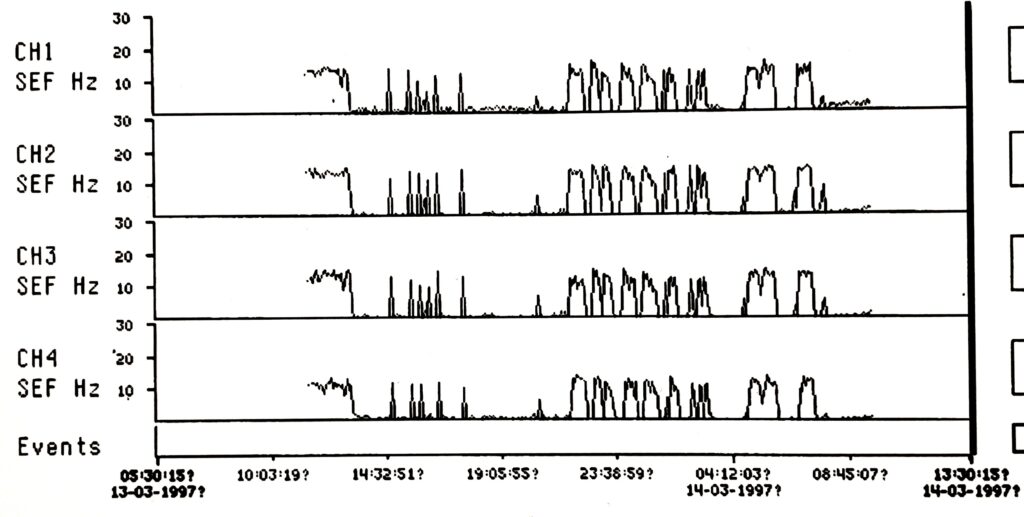 Neurotrac II Spectral Edge Frequency (SEF)